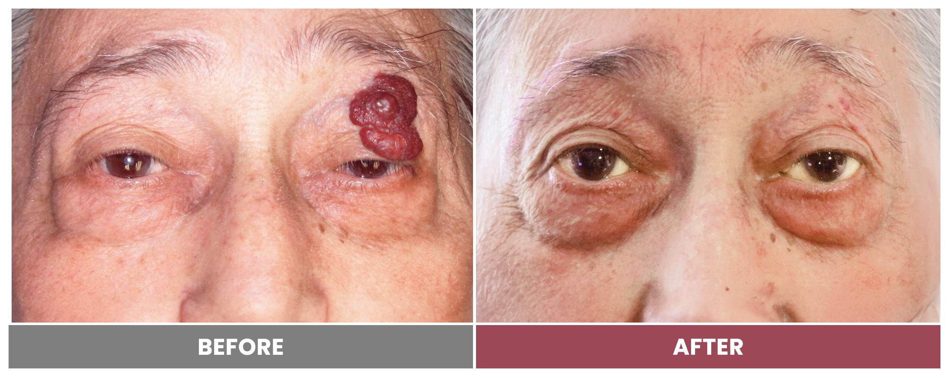 TUMOR REMOVAL AND RECONSTRUCTION - Case 9